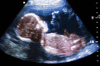 Фото исследования на 20 неделе беременности