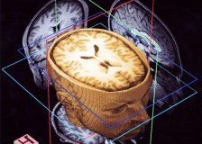 Как делают МРТ головного мозга?