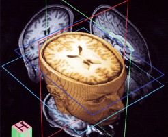 Как делают МРТ головного мозга?