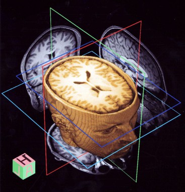 3D cнимок головного мозга