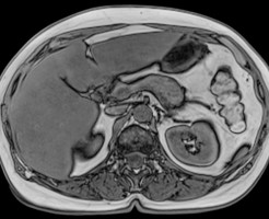 Трехформатное изображение на МРТ брюшной полости