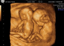 Когда можно сделать фото многоплодной беременности на УЗИ?