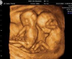 Когда можно сделать фото многоплодной беременности на УЗИ?