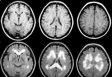 Снимки мозга томографом
