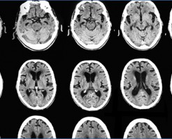 Метод нейровизуализации при помощи КТ головного мозга