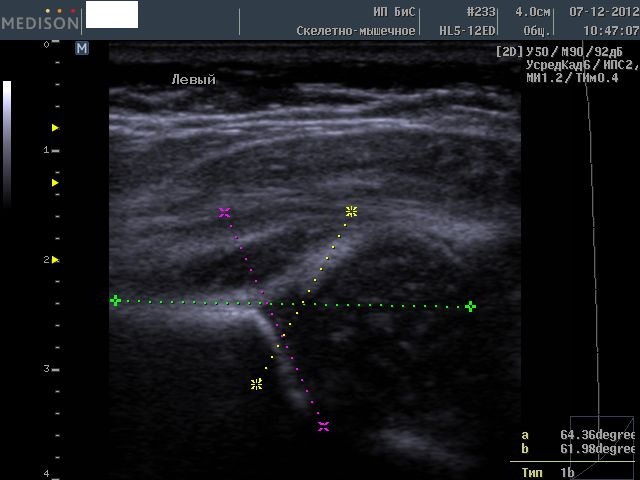 Узи тазобедренных суставов фото