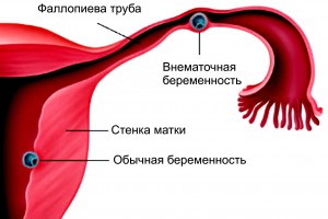 Анатомия внематочной беременности