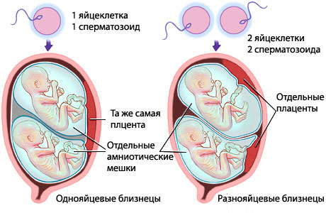 Типы многоплодной беременности