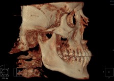 Необходимость компьютерной томографии зубов в стоматологии