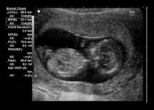 О чем расскажет фото, сделанное на УЗИ к 12 неделе беременности?