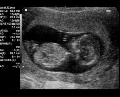 О чем расскажет фото, сделанное на УЗИ к 12 неделе беременности?
