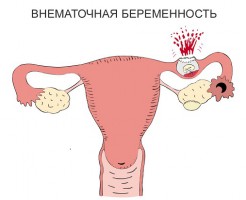 Можно ли увидеть внематочную беременность на УЗИ?
