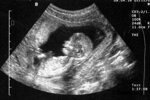 Ультразвуковое обследование на 33 неделе беременности
