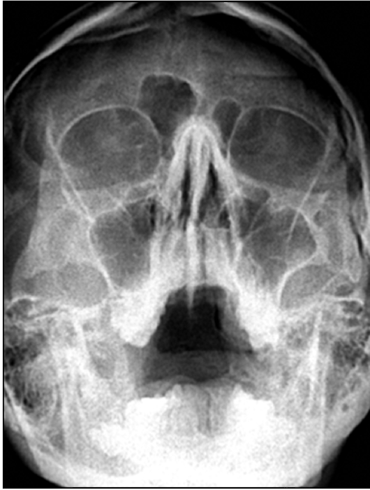 Рентгенограмма носа и околоносовых пазух