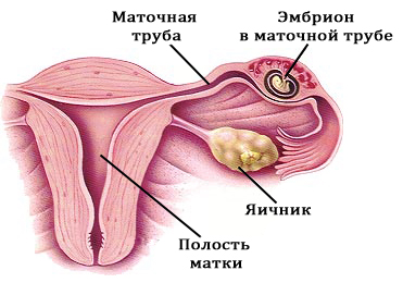 Выявление внематочной беременности