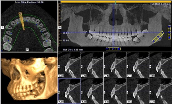 Снимки челюсти с компьютерной томографии