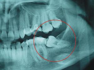 Патология зуба, видимая на рентгене