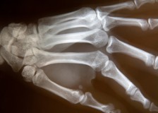 Сцинтиграфия костей — метод лучевой диагностики