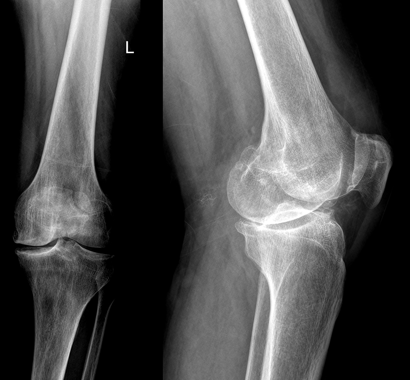 Фото колена на рентгене