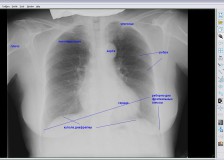 Выявление патологий на рентгене легких