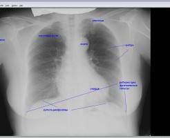 Выявление патологий на рентгене легких