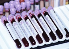 Определение воспалительных процессов по показателю СРБ в биохимическом анализе крови