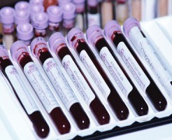 Определение воспалительных процессов по показателю СРБ в биохимическом анализе крови