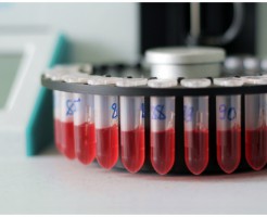 Как необходимо сдавать клинический анализ крови — натощак или нет?