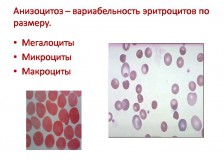 Выявление анизоцитоза в общем анализе крови