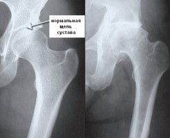 Видимые патологии на рентгене тазобедренного сустава