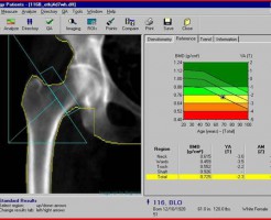 Диагностика остеопороза при помощи метода денситометрии