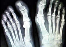 Что можно увидеть на рентгене ноги?