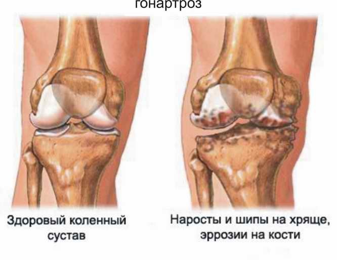 Патологии коленного сустава
