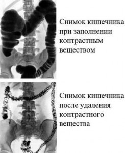 Рентгеновские снимки кишечника
