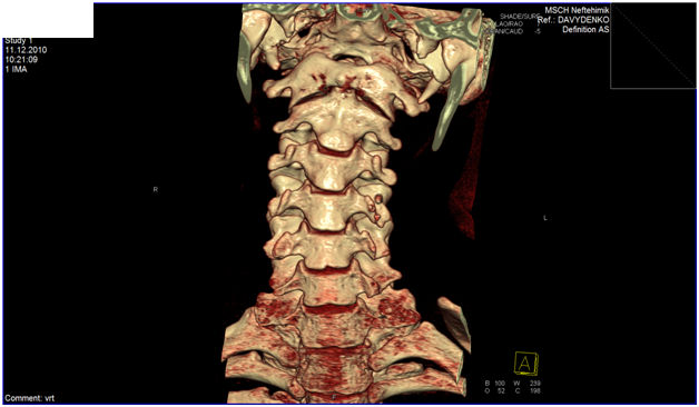 Кт шеи сделать. Грыжа шейного отдела позвоночника кт. Мрт шейного отдела позвоночника остеохондроз. Остеохондроз грудного отдела кт. Шейный остеохондроз снимки мрт.