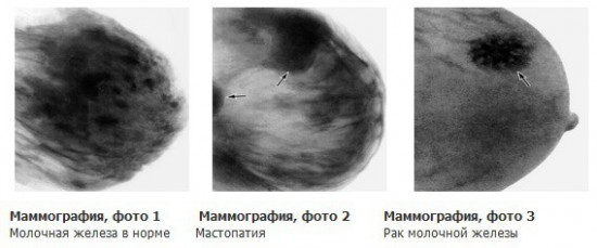 Заболевания на снимке маммографа