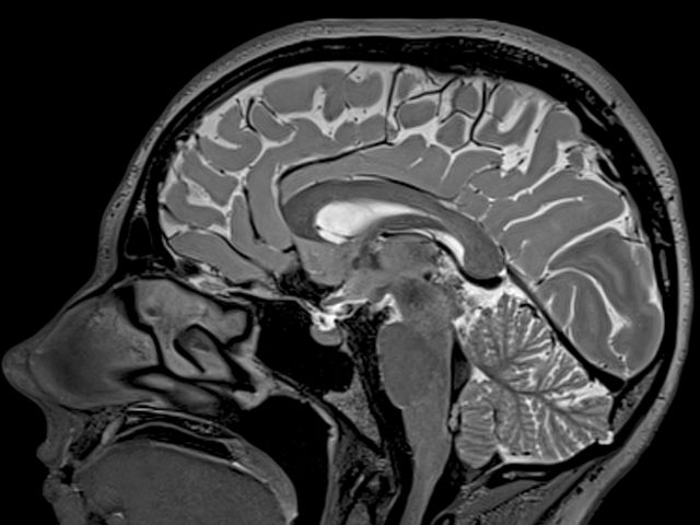 Снимок мозга на МРТ