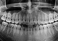 Показания для проведения рентгена зубов