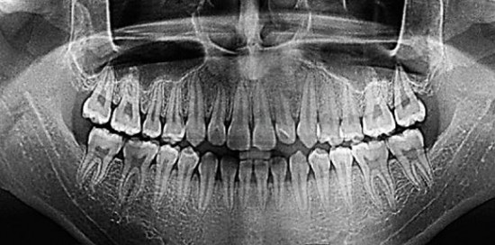 Общий снимок зубов - отропантомограмма