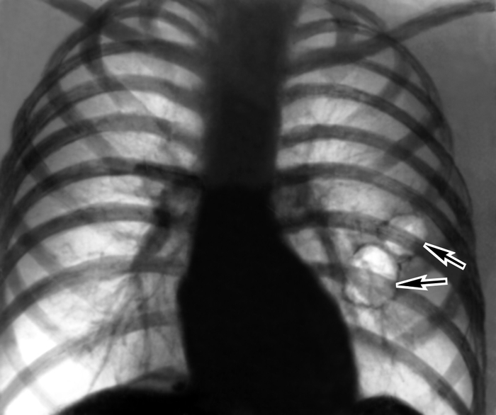 Рентгенограмма с новообразованиями