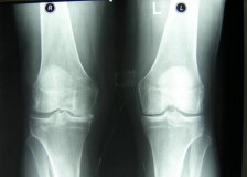 Изменения и патологии на рентгене коленного сустава