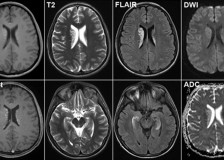 Какое исследование лучше — КТ или МРТ головного мозга?