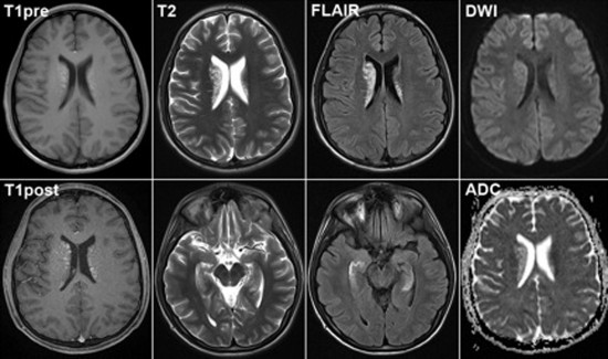 Снимки мозга на МРТ