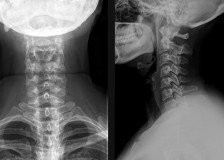 Изучение состояния шеи на рентгене шейного отдела позвоночника