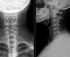 Изучение состояния шеи на рентгене шейного отдела позвоночника