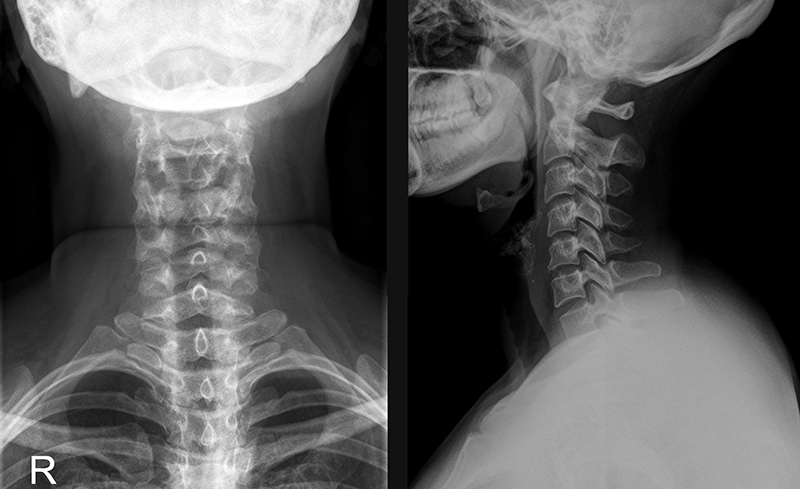 Рентгеновский снимок позвонков шейного отдела