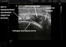 Исследование травм и заболеваний на УЗИ плечевого сустава