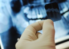 Вредно ли делать рентген зуба при беременности?
