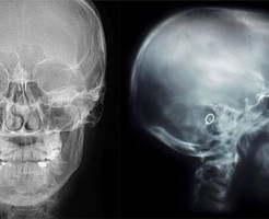 Когда назначают рентген головы?