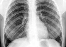 Что показывает рентген грудной клетки?